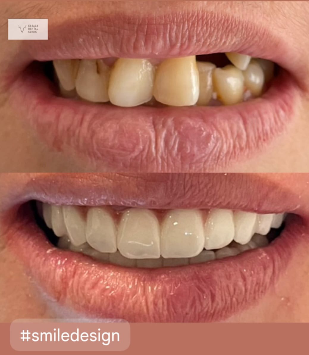 Alanyada Diş Kliniği | KARACA DENTAL CLINIC